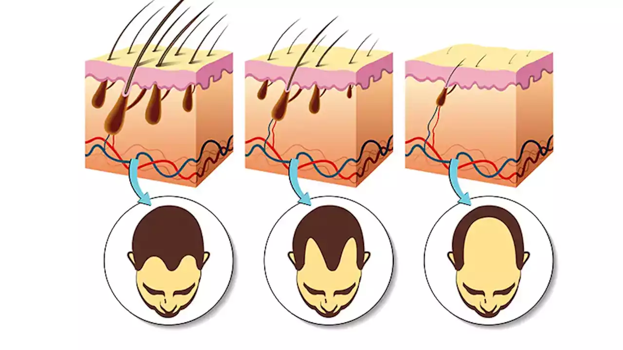 Fast Five Quiz: Hair Loss (Alopecia)