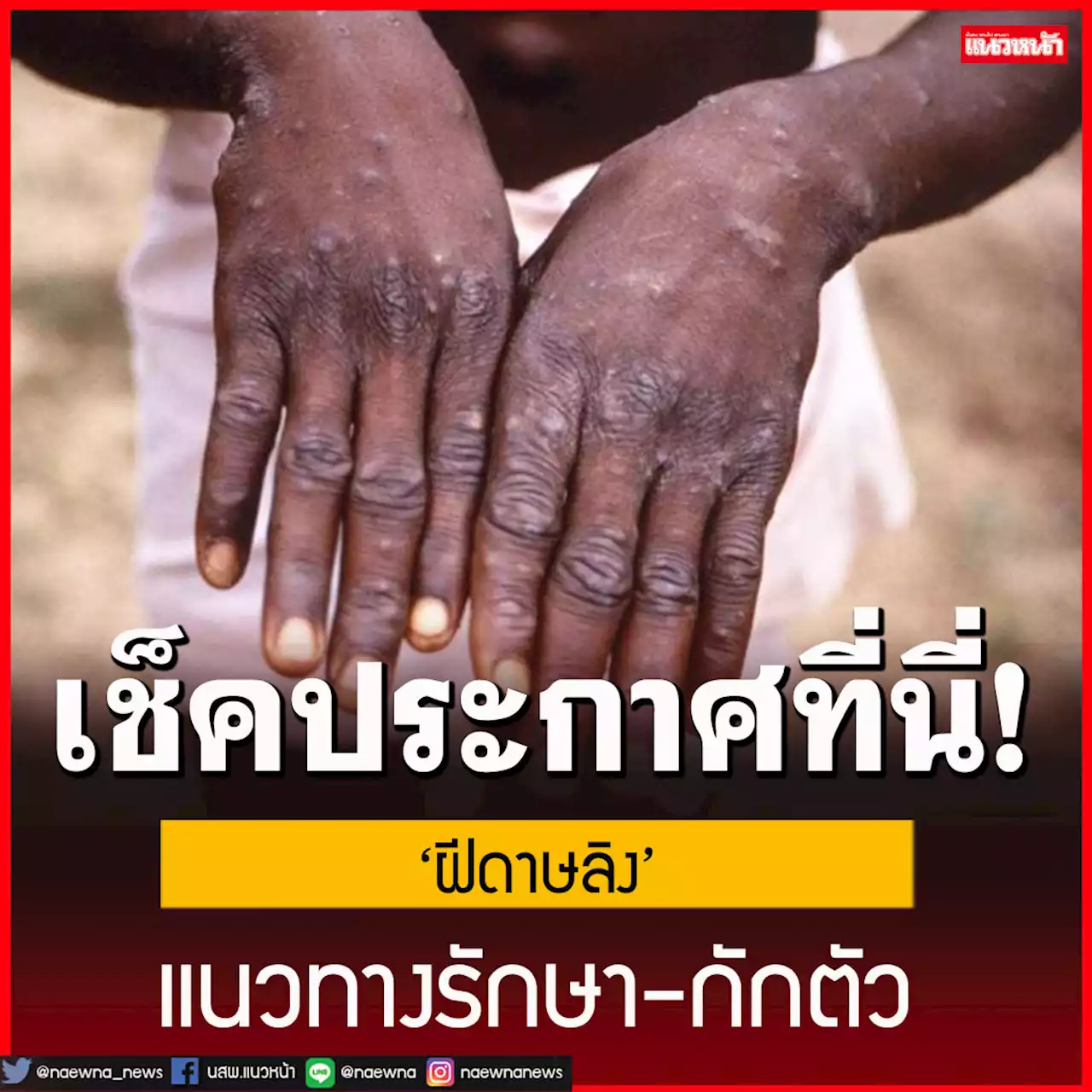 เช็คที่นี่!กรมการแพทย์คลอดประกาศแนวทางรักษา-กักตัว‘ฝีดาษลิง’