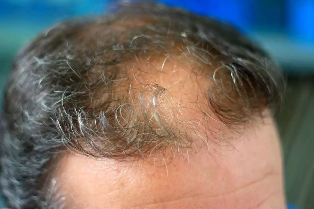 Long covid symptoms may include hair loss and ejaculation difficulties