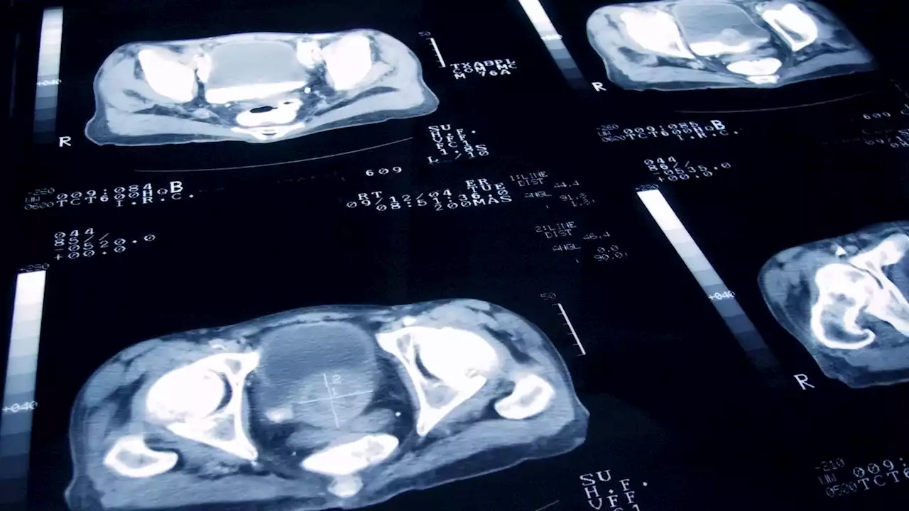 Prostate scan could save thousands of unnecessary biopsies, charity says