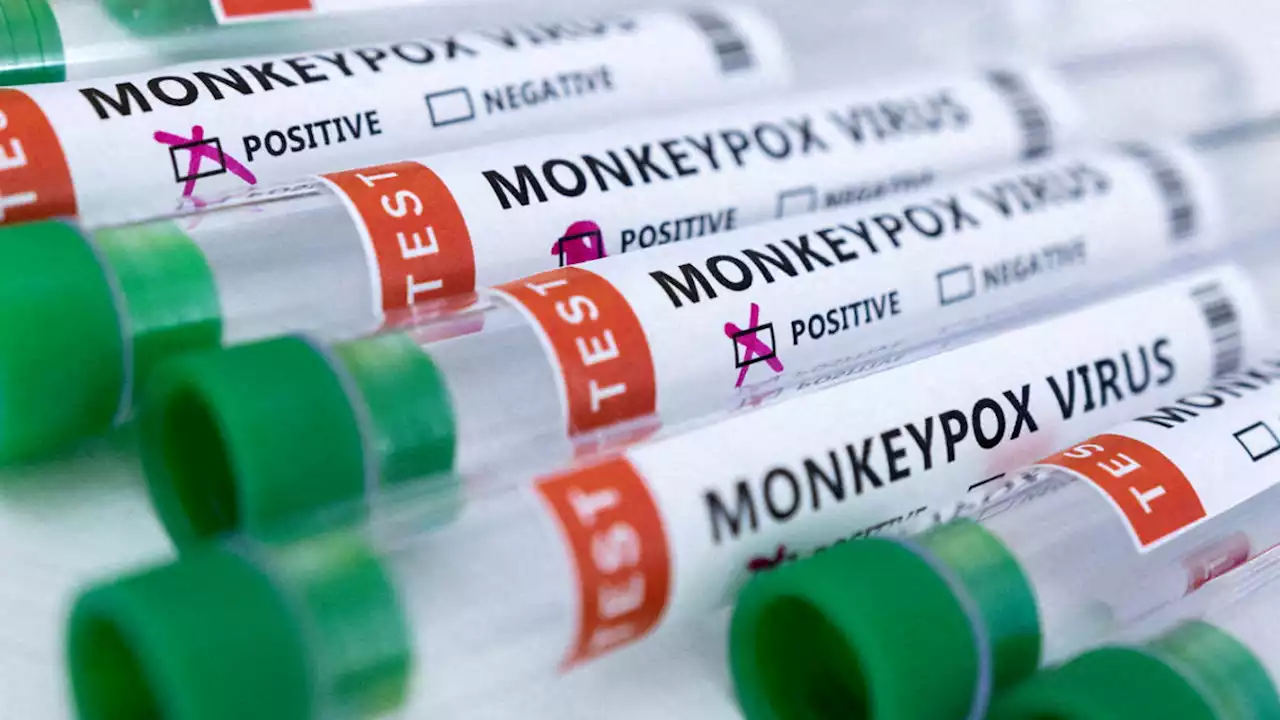 Texas reports 1st death tied to monkeypox in the U.S.