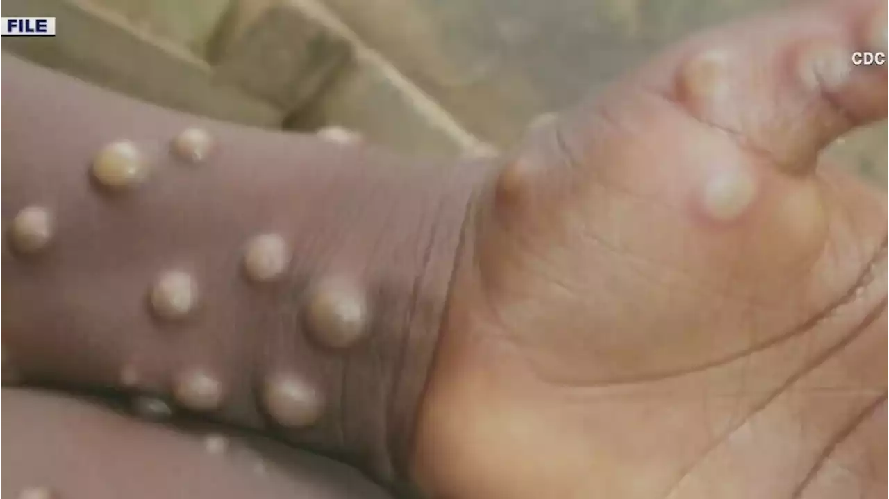 Texas reports first U.S. death in person with monkeypox