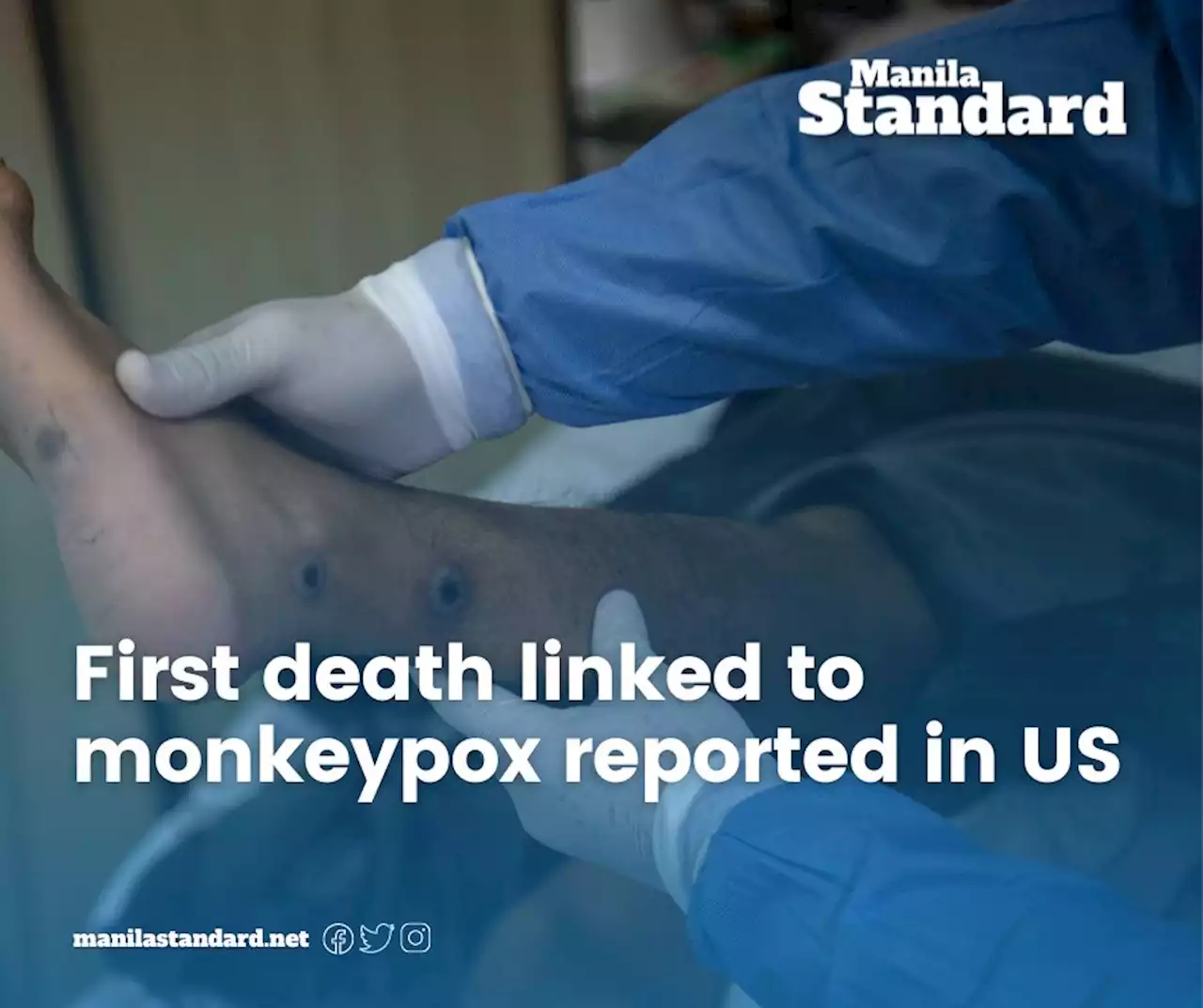 First death linked to monkeypox reported in US