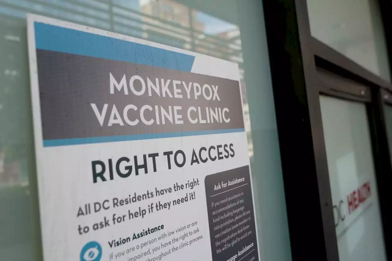 Person with monkeypox dies in Texas