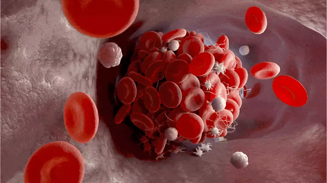 COVID-19 Research Reveals Additional Link Between Immune System and Blood Clots