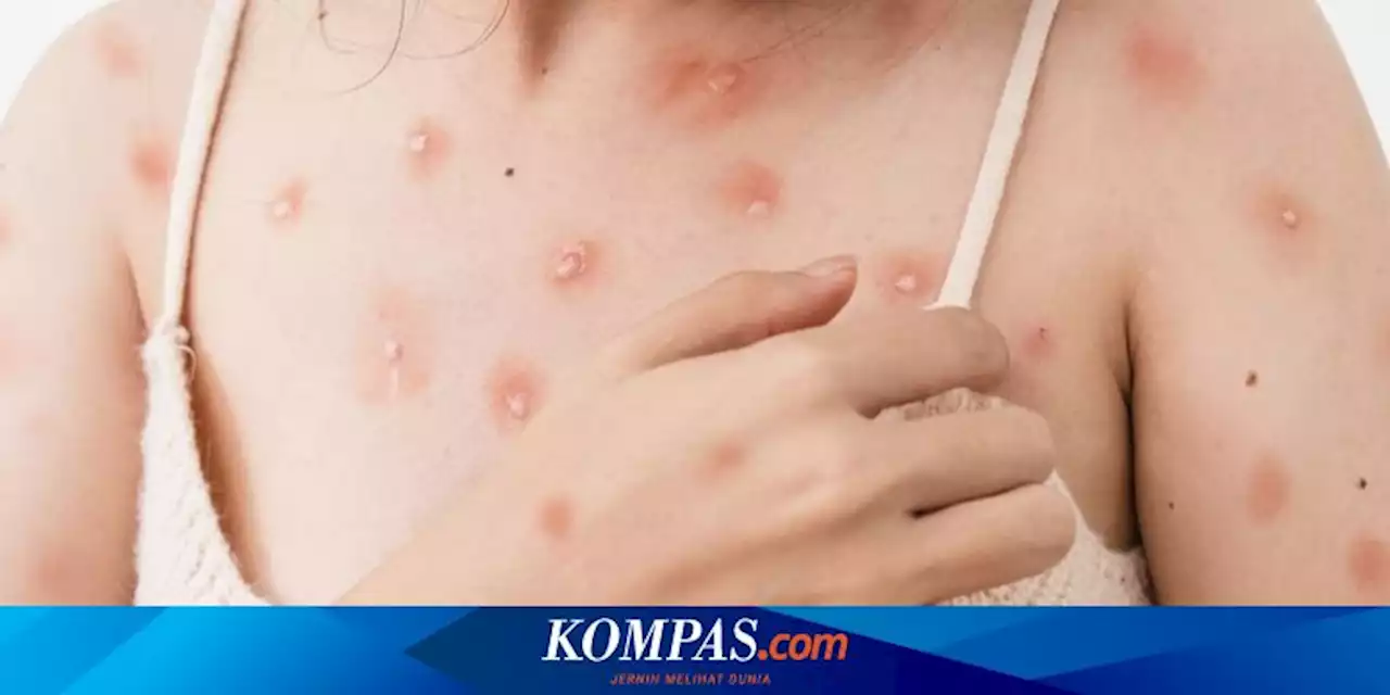 8 Perbedaan Cacar Monyet, Cacar Air, dan Cacar yang Sekilas Mirip