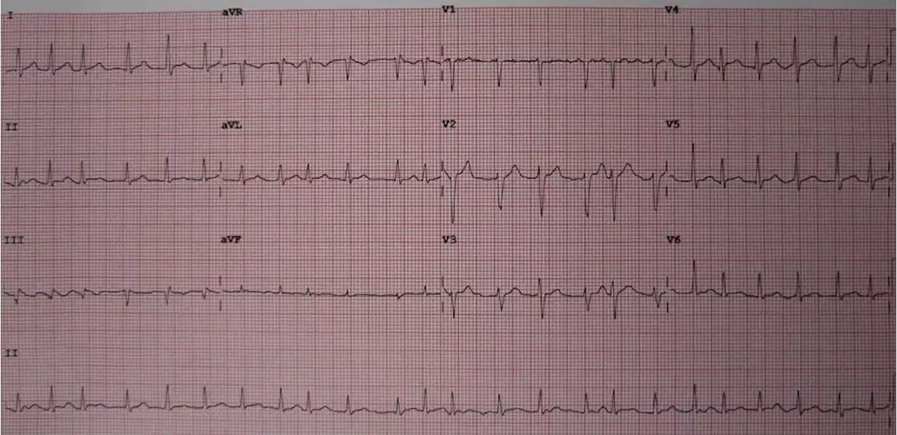 Wrist-worn devices are shown to be cost-effective for screening of atrial fibrillation