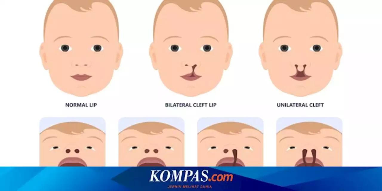 Anak Alami Bibir Sumbing, Apa Tindakan Medisnya?