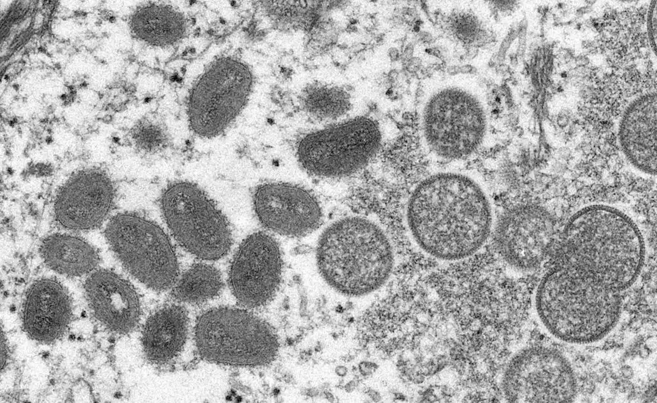 Monkeypox less fatal than Covid-19—expert