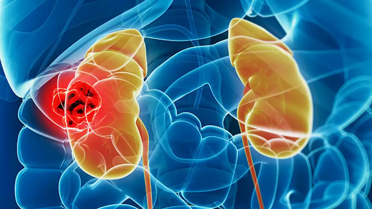 Targeted Therapy for Kidney Cancer Linked to Higher Cardiac Risk