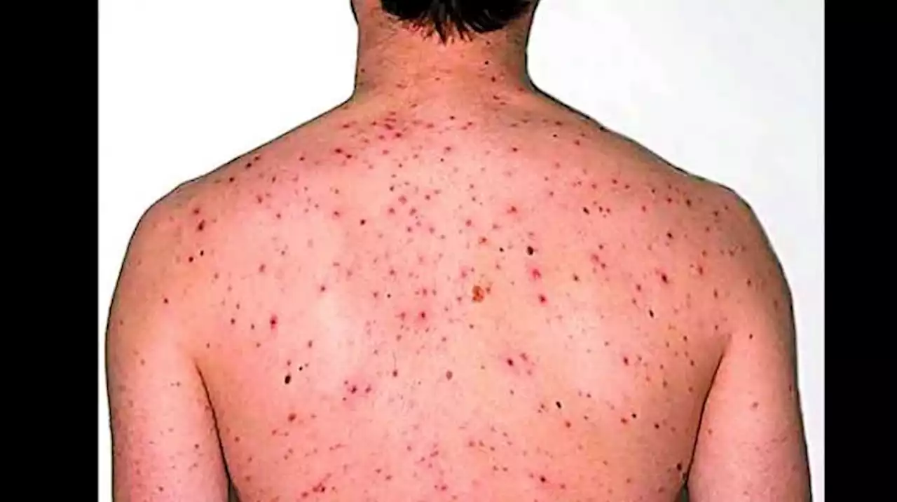 Monkeypox: U.S. records over 6,000 cases, declares public emergency