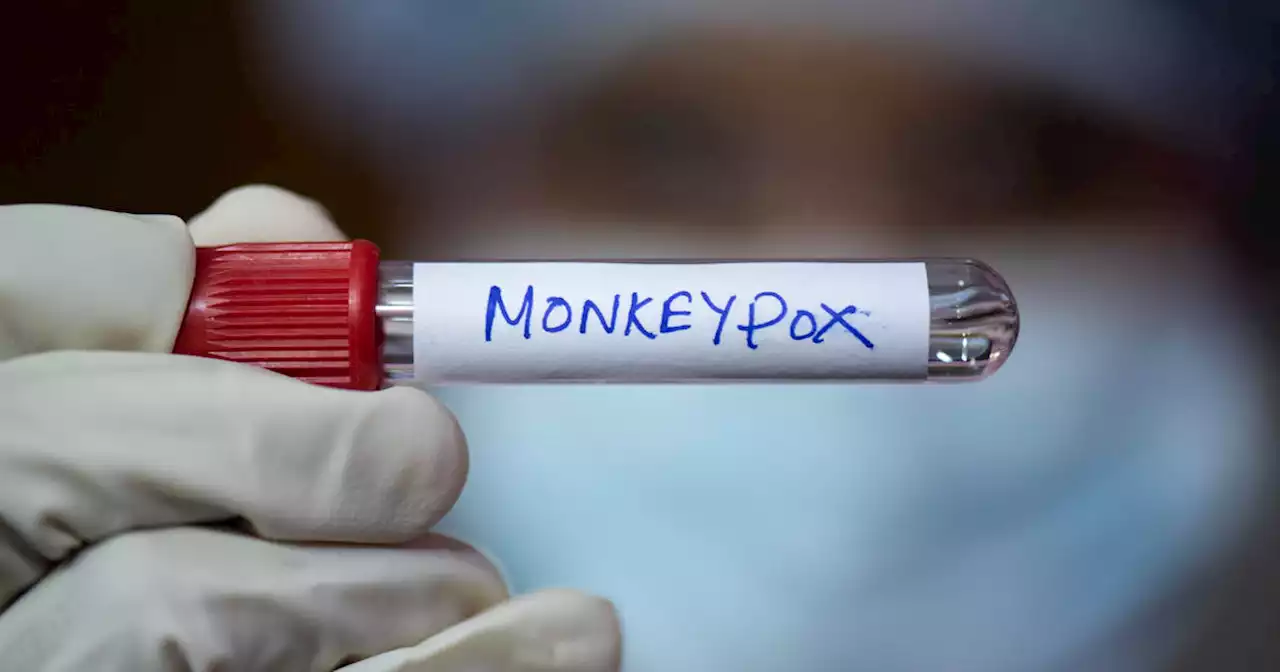 Chicago expecting 20,000 more monkeypox doses in coming weeks.