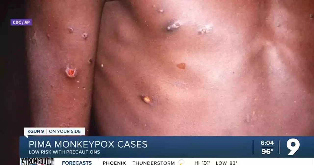 Pima Health says monkeypox a low risk