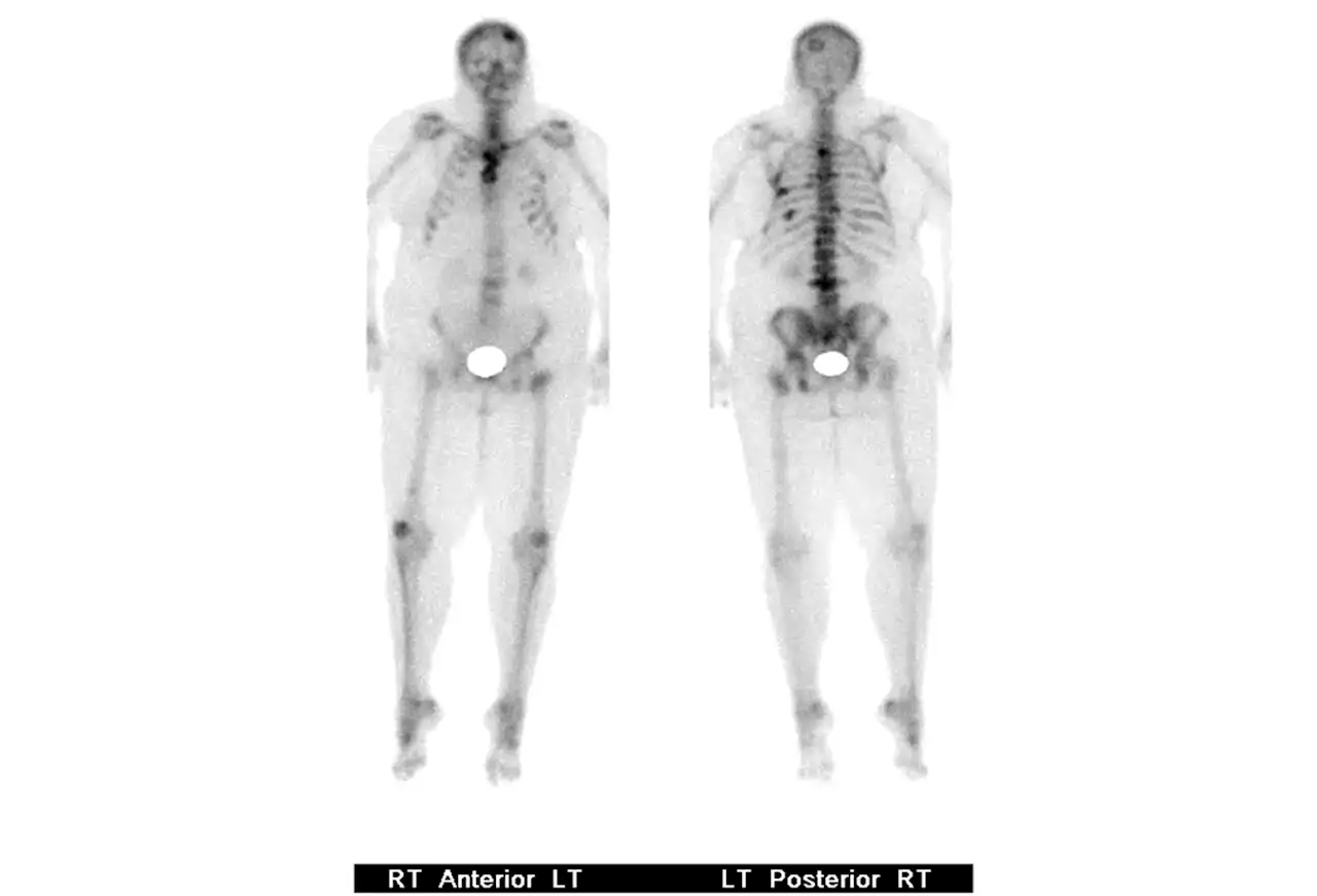 Metastatic Breast Cancer: A Review of 3 Cases and Palliative Care