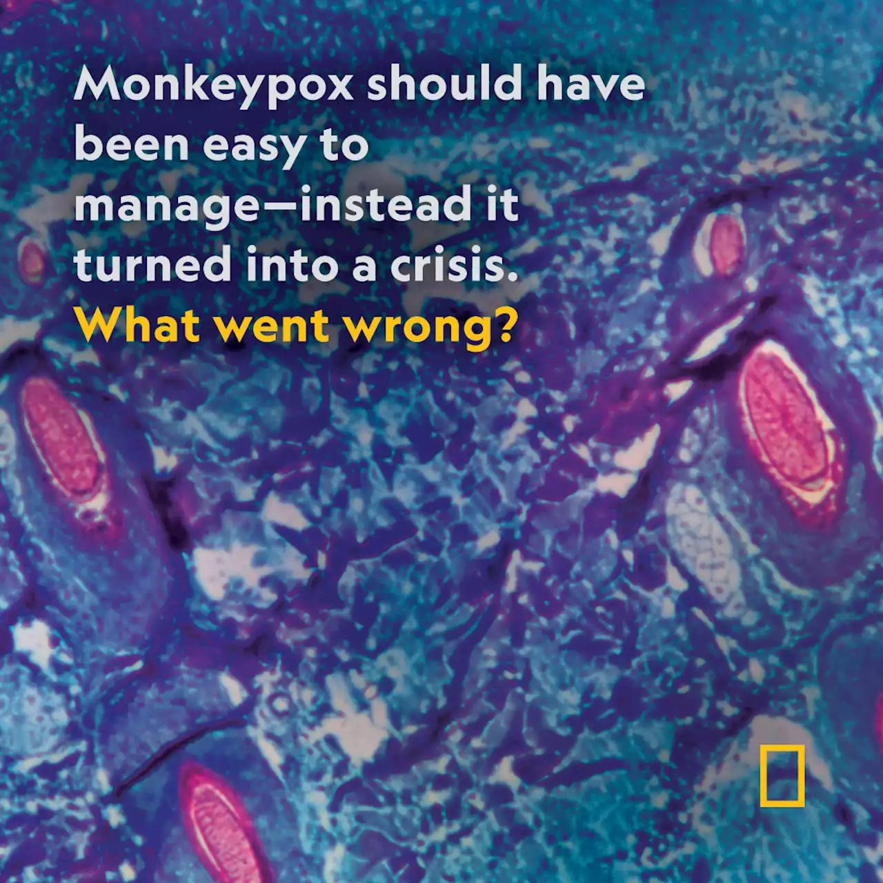 Why monkeypox cases are still rising at such an alarming rate