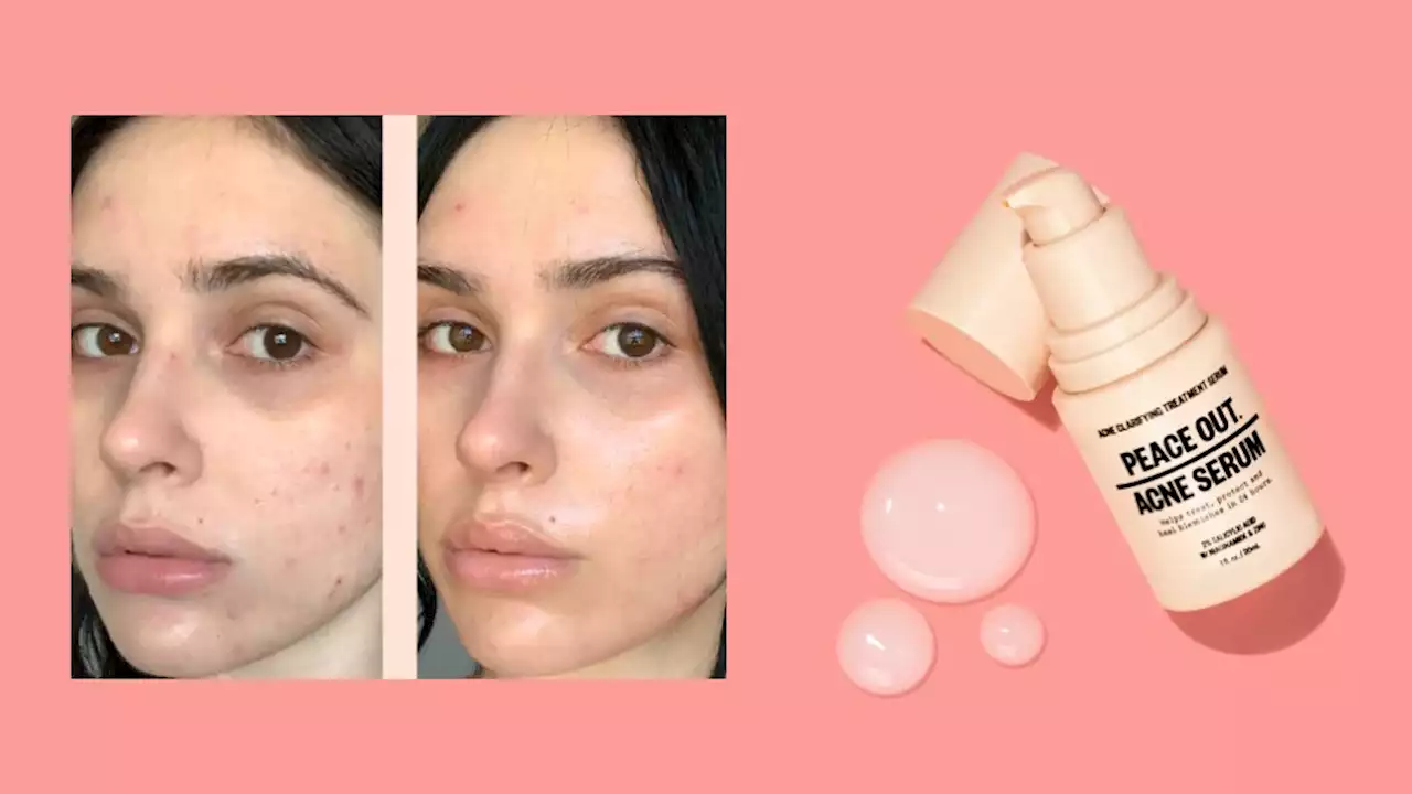 I Tested ‘The Holy Grail of Acne Serums’ & It Cleared Up My Face in a Week—Get it For 25% Off