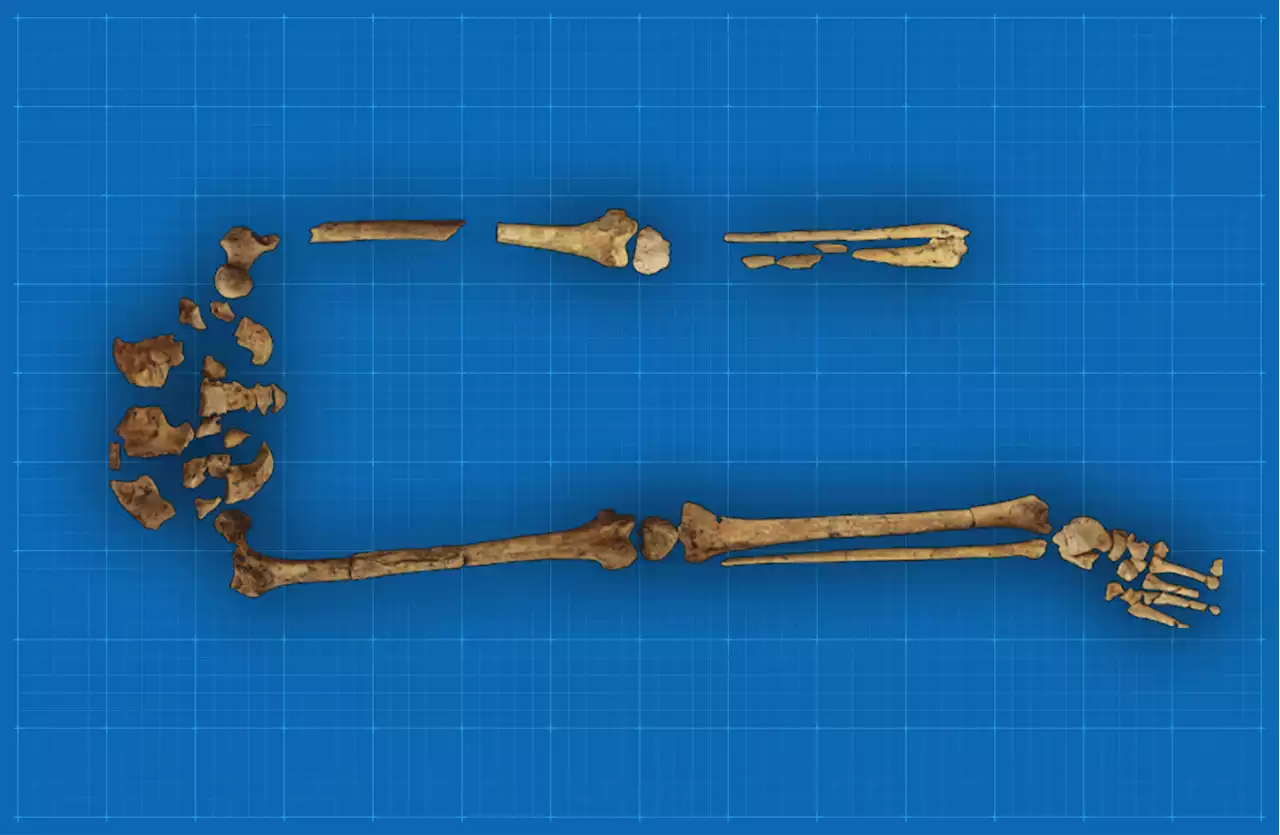 A discovery pushes the earliest known medical amputation back 31,000 years