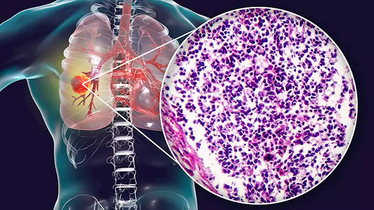 Fast Five Quiz: Non-Small Cell Lung Cancer and RET Mutation