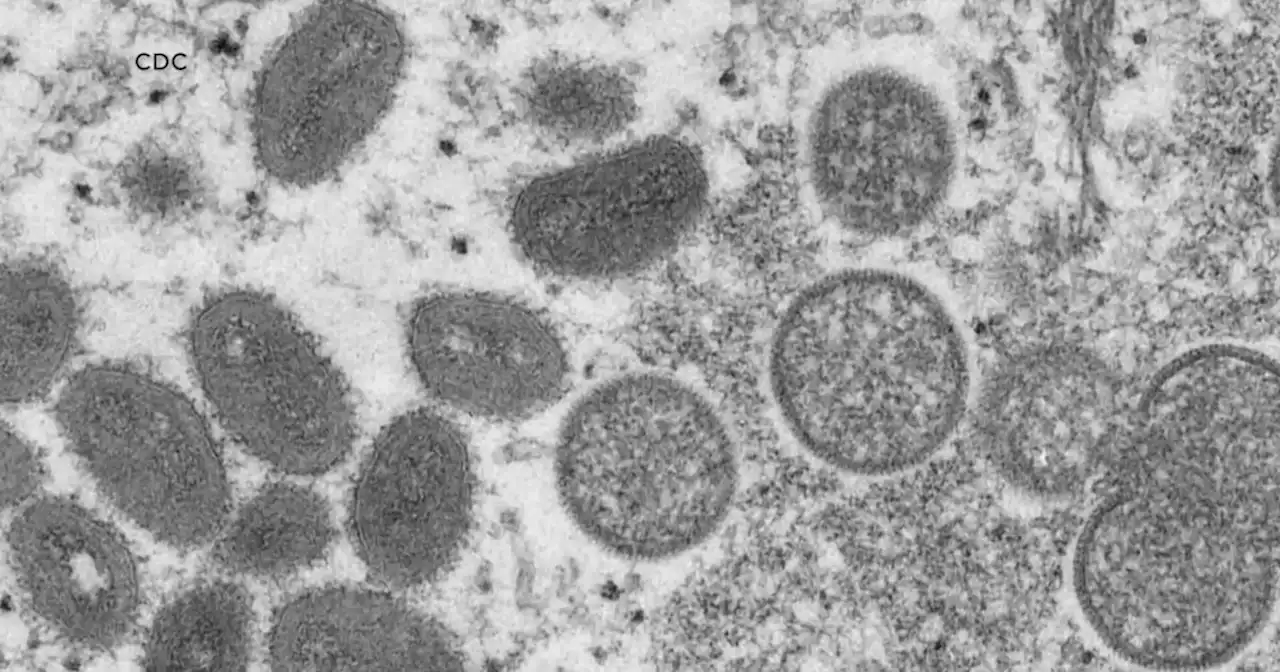 LA County confirms first death due to monkeypox