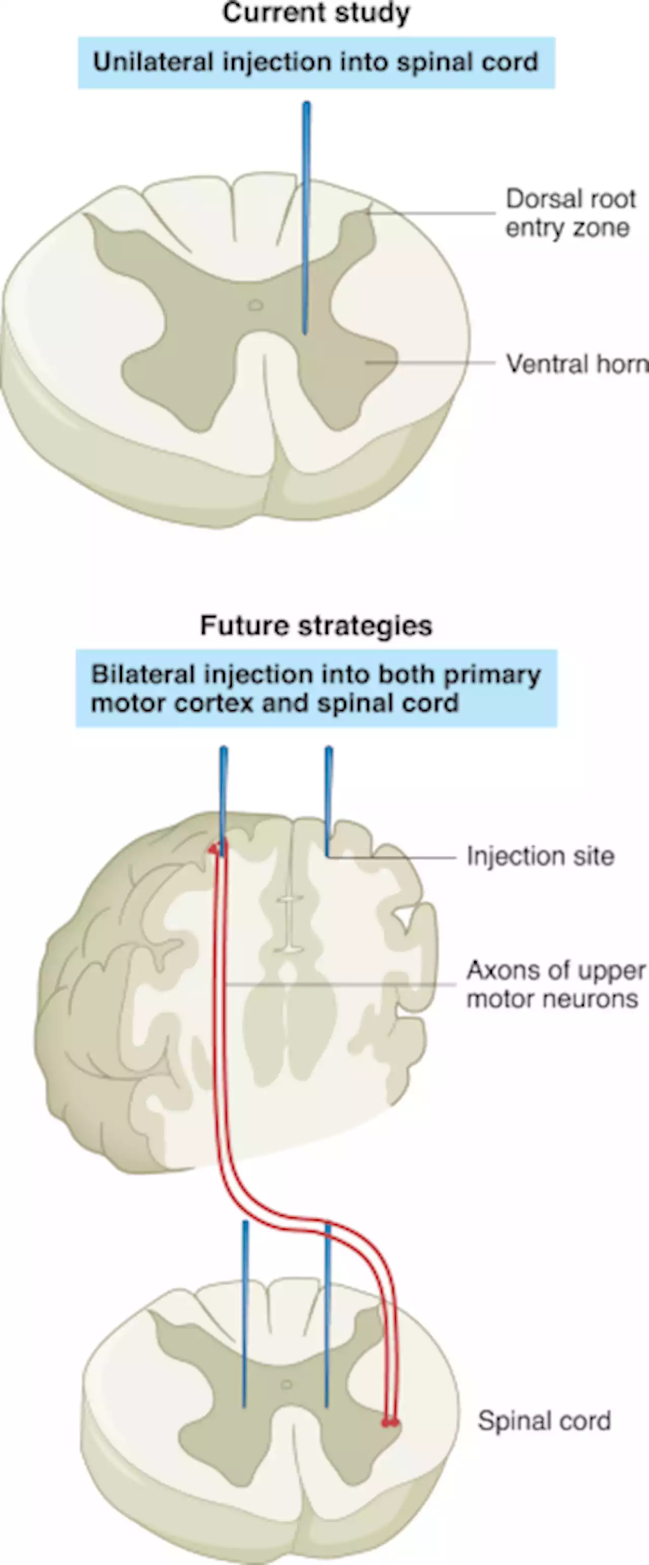 A combined stem-cell–gene therapy strategy for ALS - Nature Medicine