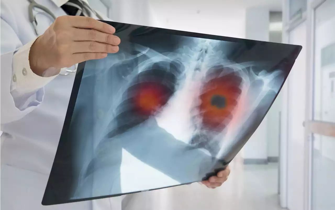 Study uncovers how air pollution can trigger lung cancer in individuals with no history of smoking