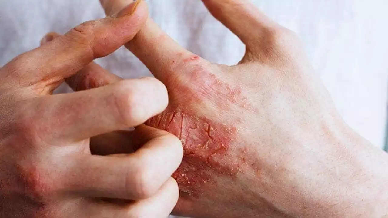 Many Factors Linked With Higher, Lower Risk for Hand Eczema