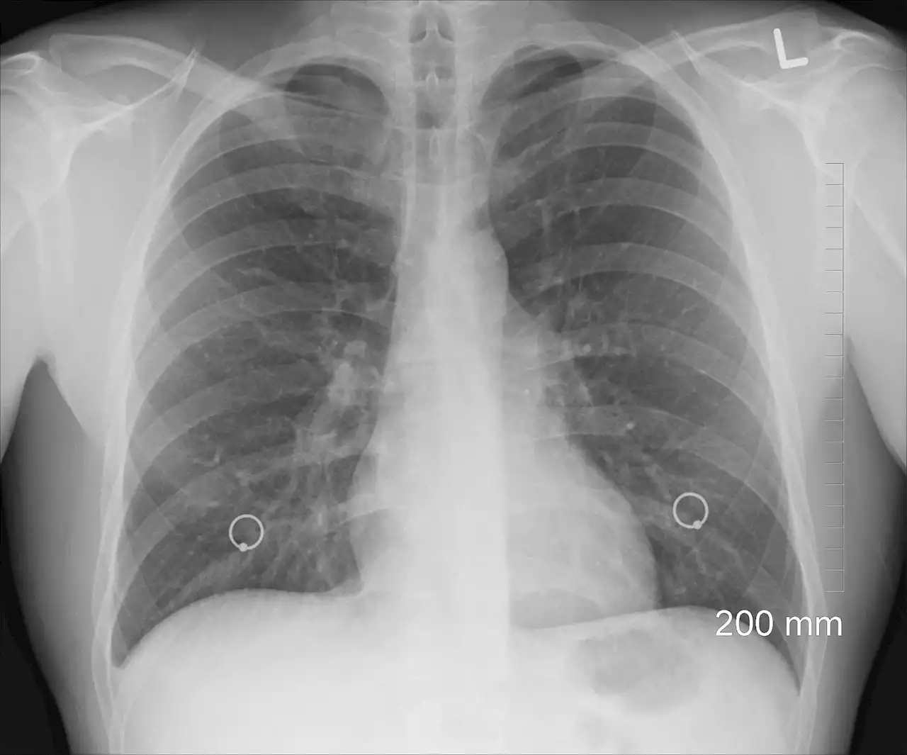 No labels? No problem! New tool overcomes major hurdle in clinical AI design