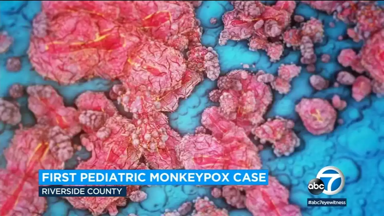 Riverside County reports its 1st case of child with monkeypox