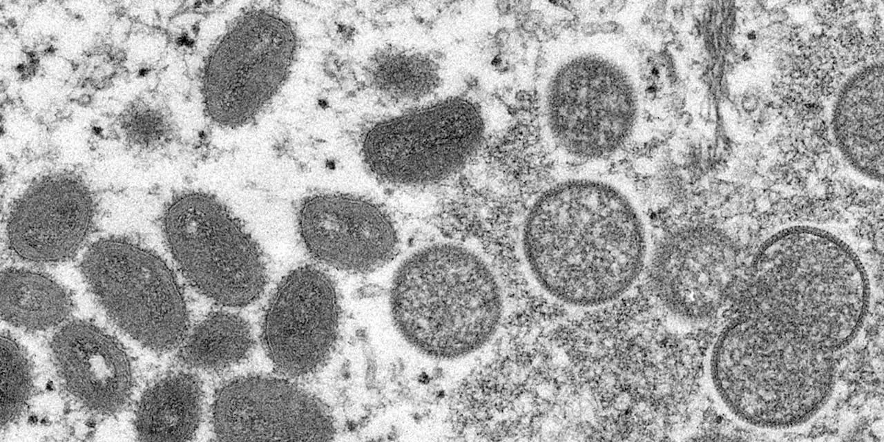 US warns monkeypox could mutate to resist antiviral drug