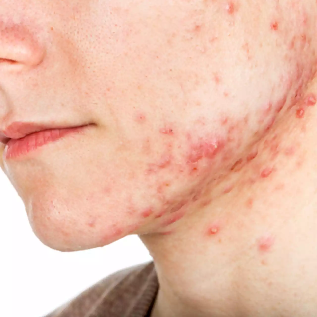 Hormonal therapy a safe, long term option for older women with recalcitrant acne