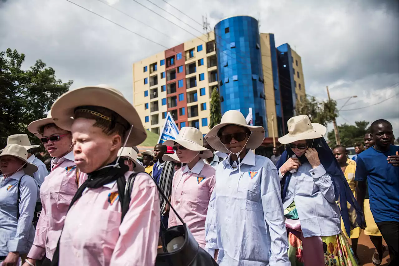 No justice in Zambia for survivors of attacks against people with albinism