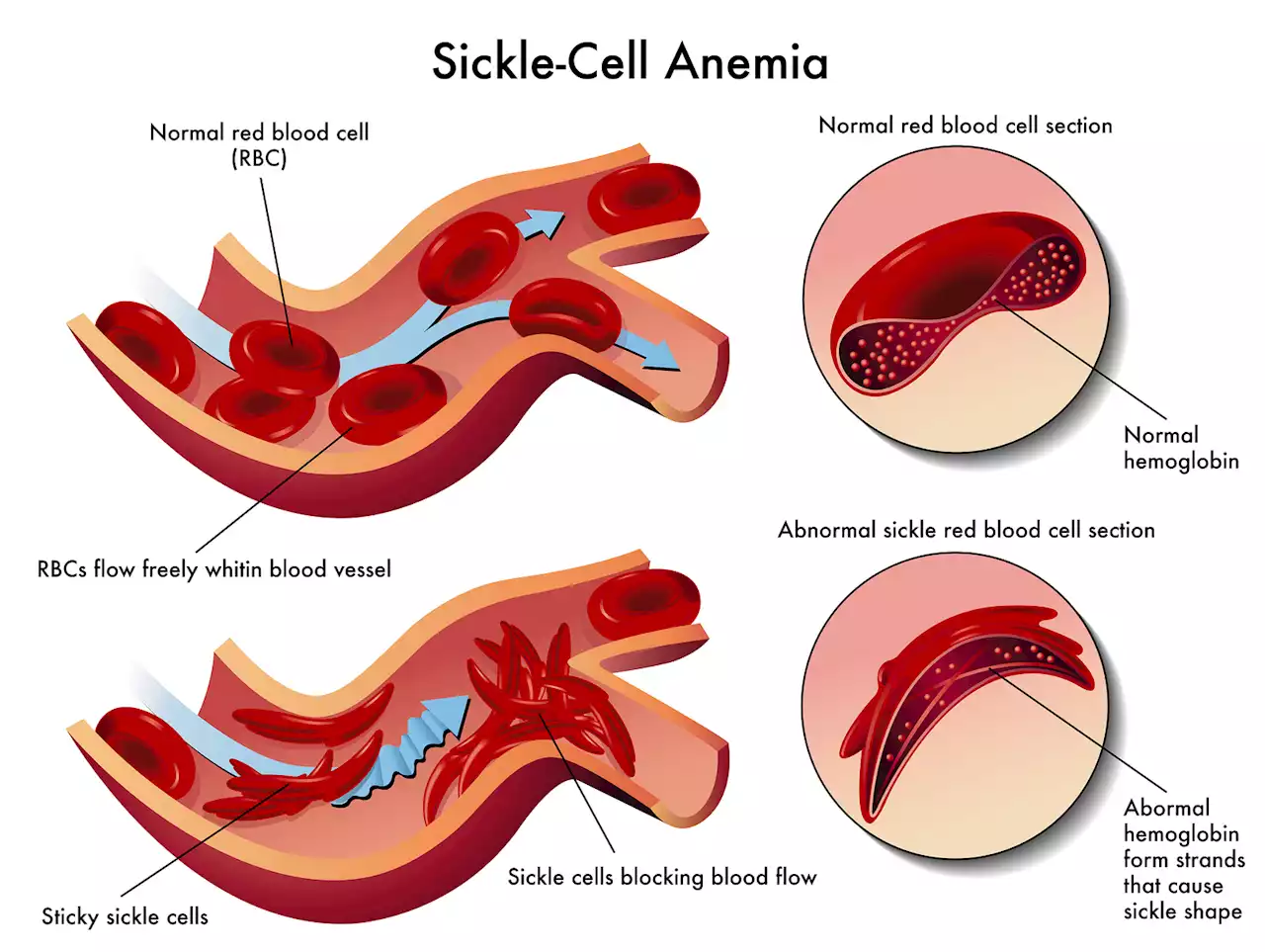 New York Blood Center offering free sickle cell trait testing - New York Amsterdam News