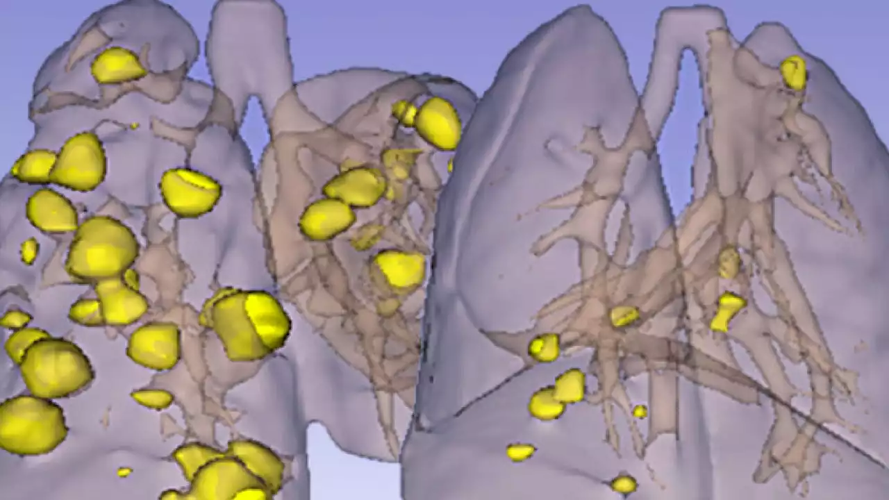 Old drug could be the new key to treating the deadliest form of lung cancer