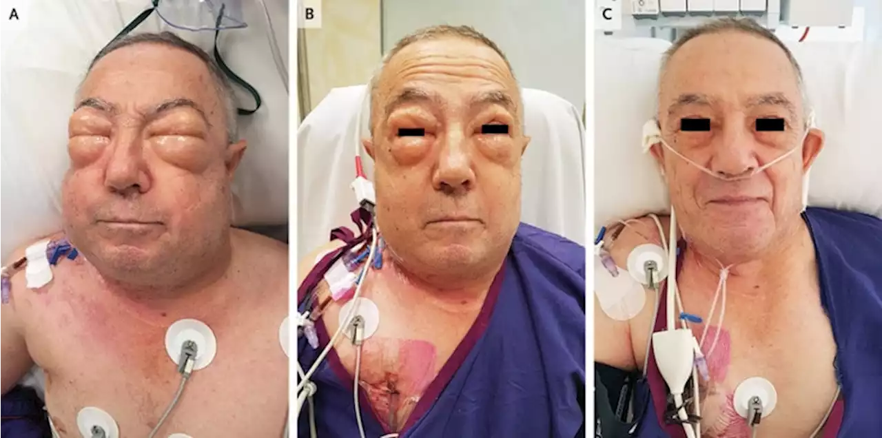 Le retiran parte del pulmón y se le hinchan los párpados; no puede abrir los ojos