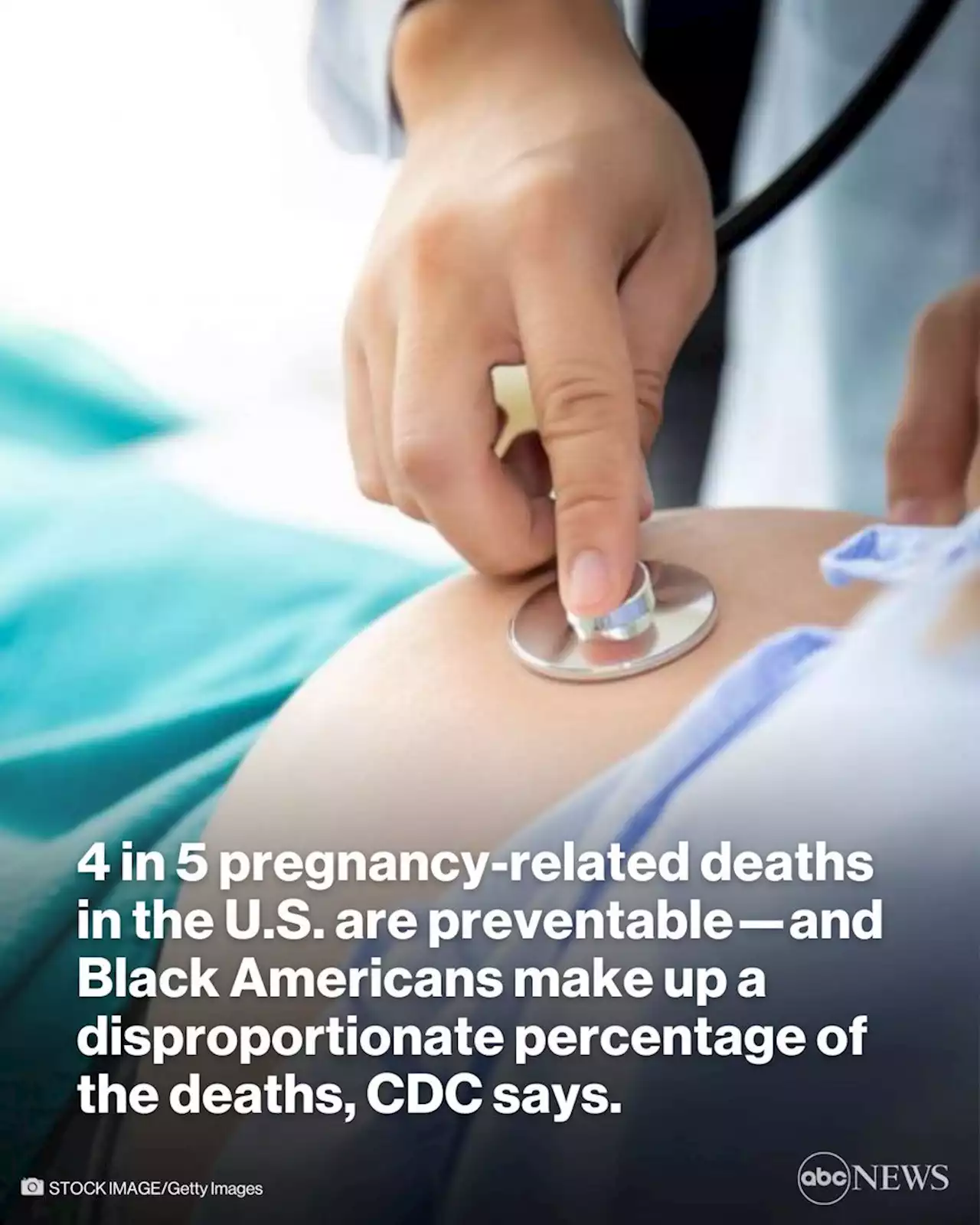 4 in 5 US pregnancy-related deaths are preventable: CDC