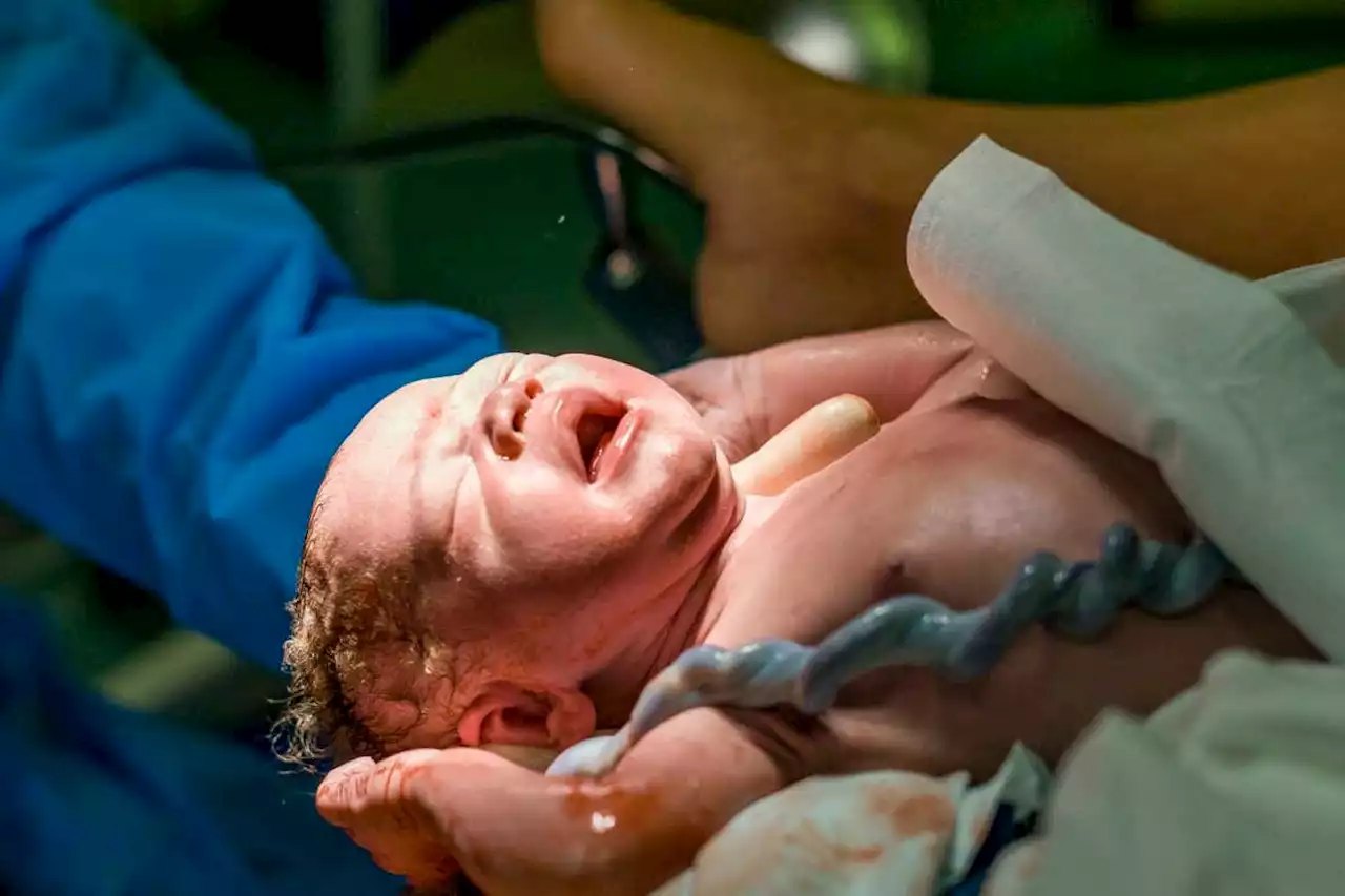 Umbilical cord 'milking' cuts brain injury risk for babies born limp