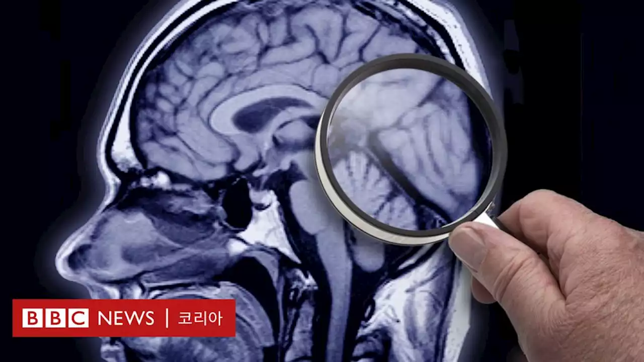 지난 4년 동안 등장한 알츠하이머 치료의 4가지 희망 - BBC News 코리아