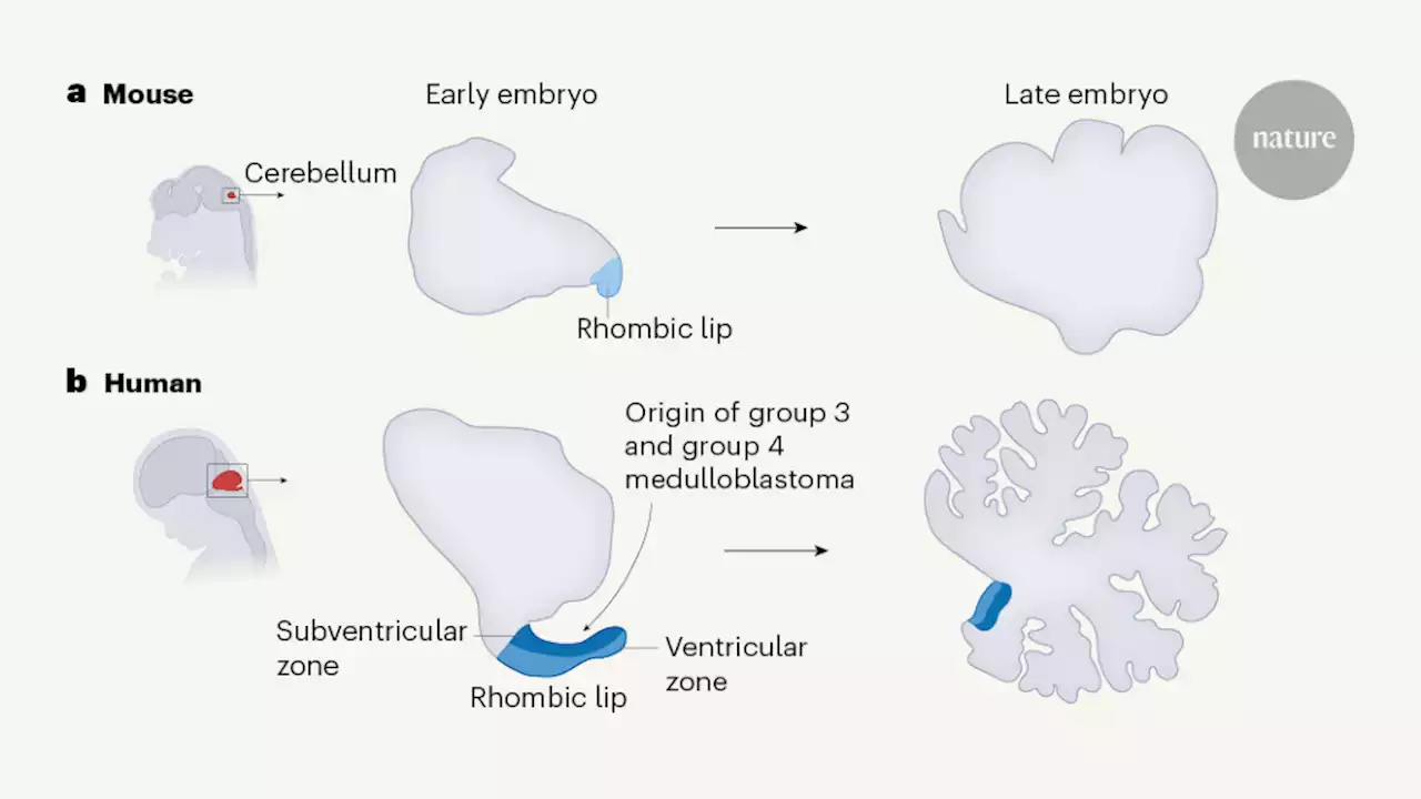 The origins of medulloblastoma tumours in humans