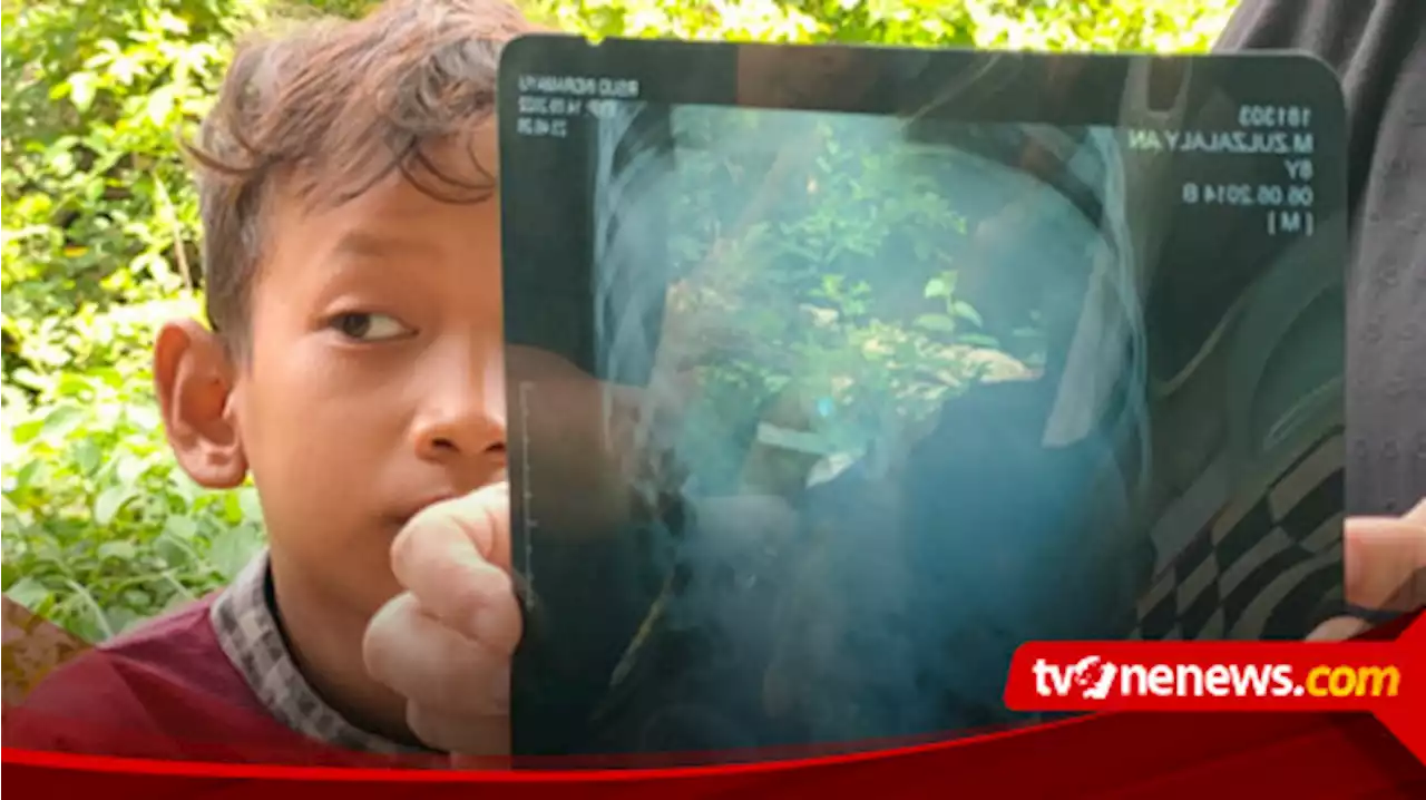 Karena Iseng, Anak Kecil Bermain Kunci Gembok Hingga Kunci Masuk ke Tenggorokan Selama Seminggu