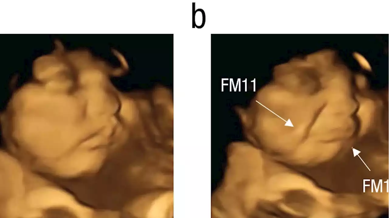 Alla carota si sorride, per il cavolo si piange: le buffe ecografie 3D dei bambini