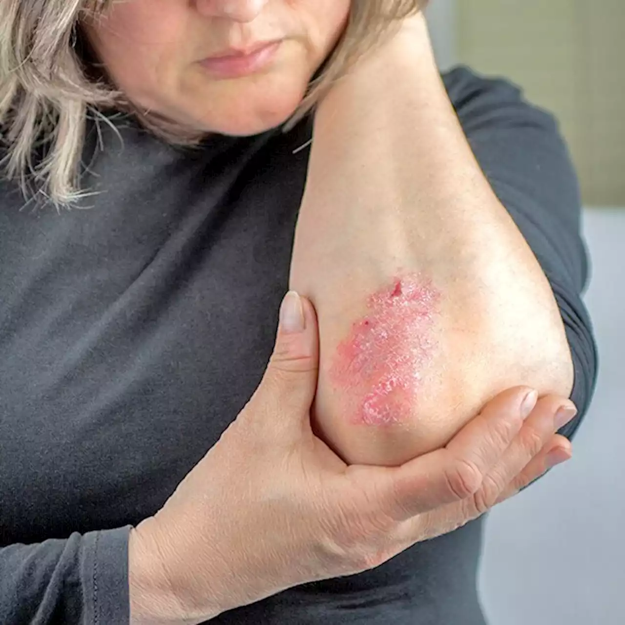 Psoriasis Types, Images, Treatments