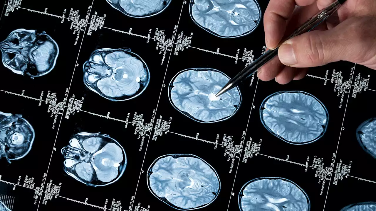 Alzheimer's disease diagnosis based on fabricated data — here's what it means