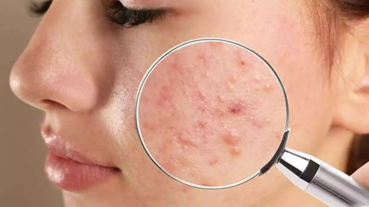 'Acne Fighter' Cari Produk yang Hilangkan Jerawat dan Bekasnya