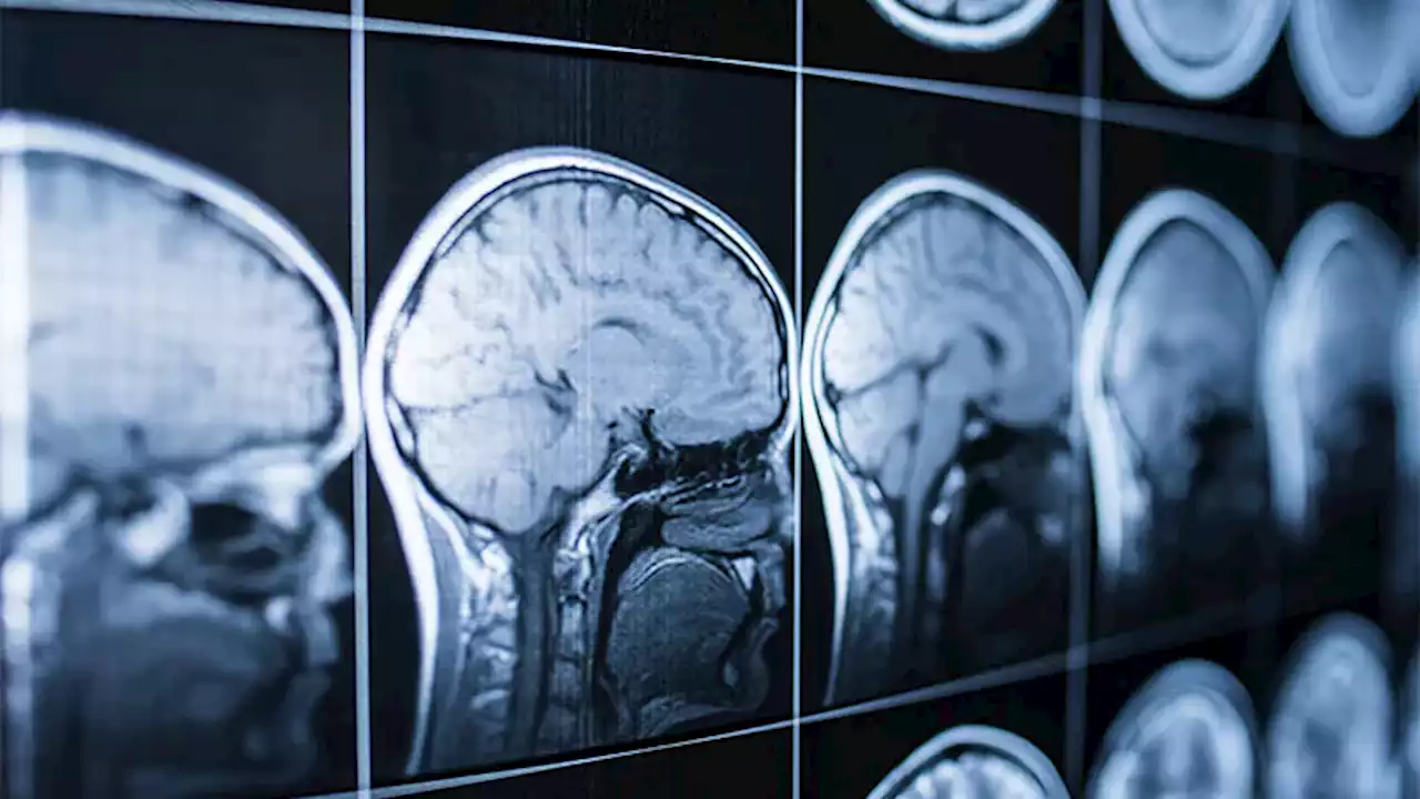 A History of Head Trauma May Predict Parkinson Progression