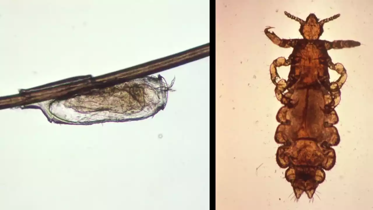 Doctors Roll Out New Guidance for Head Lice