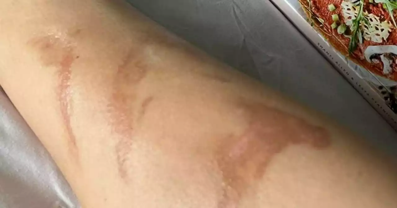 Traveller issues warning about surprise burn marks that can take years to heal