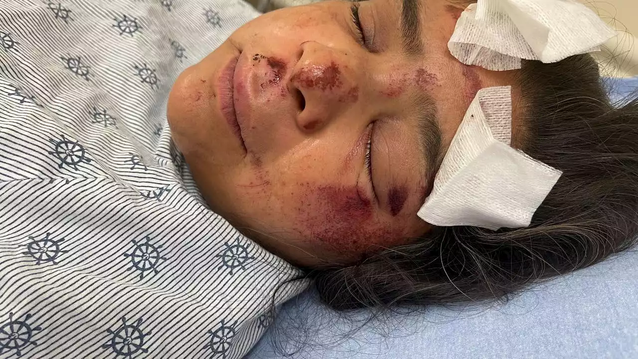 'Why wouldn’t somebody stop to see if we were ok?' Victim of Tuesday pedicab hit-and-run crash speaks