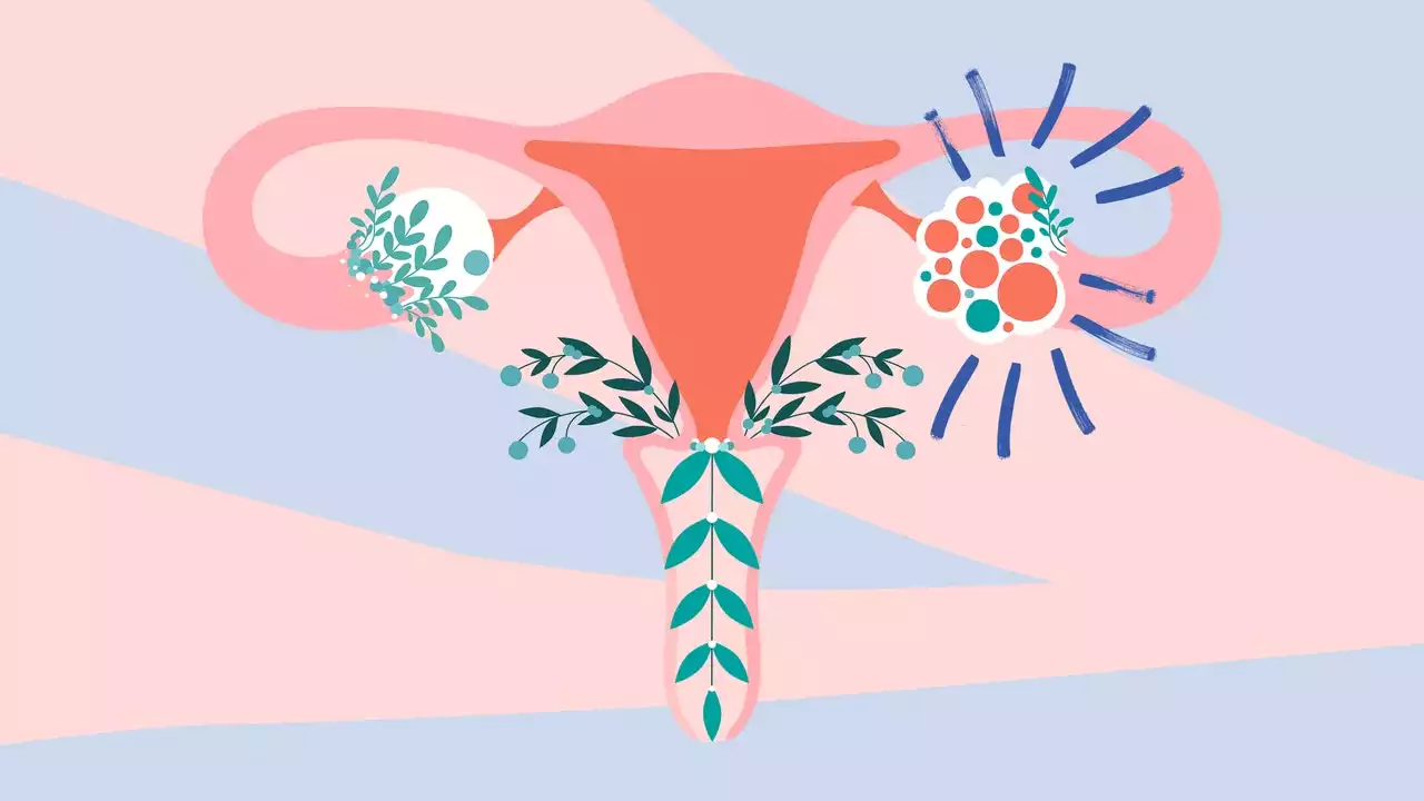 A guide to polycystic ovary syndrome, including what it's really like to live with the under-discussed condition