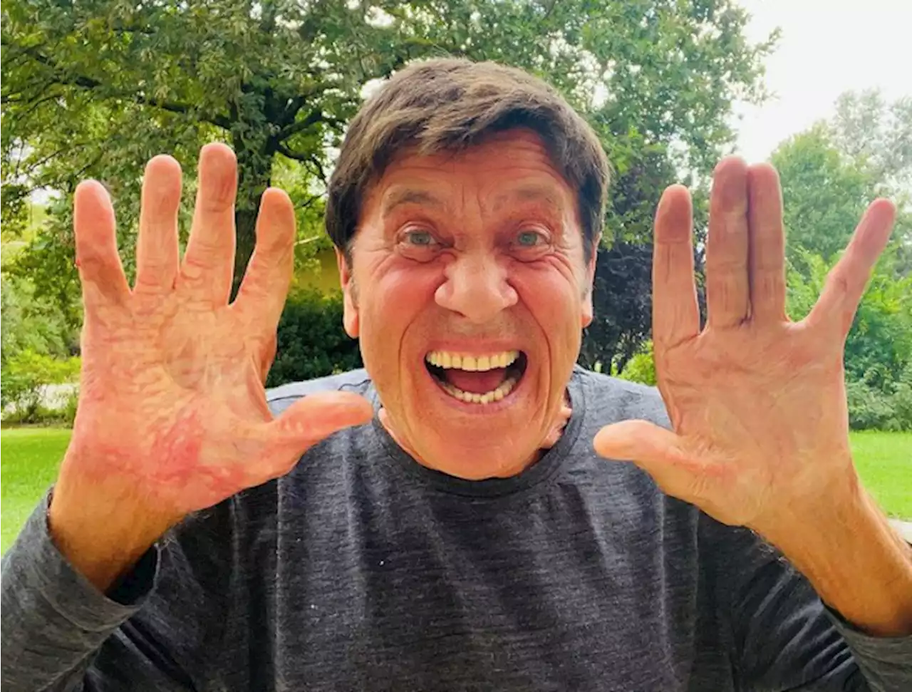 Gianni Morandi mostra sui social le mani dopo l’incidente: «Voglia di urlare!» - iO Donna