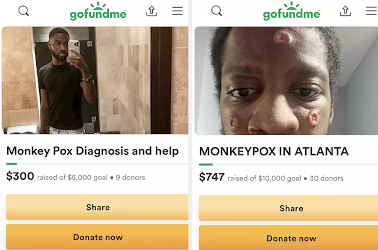 Some Monkeypox Patients Who Can’t Take Sick Leave Are Turning To GoFundMe To Survive